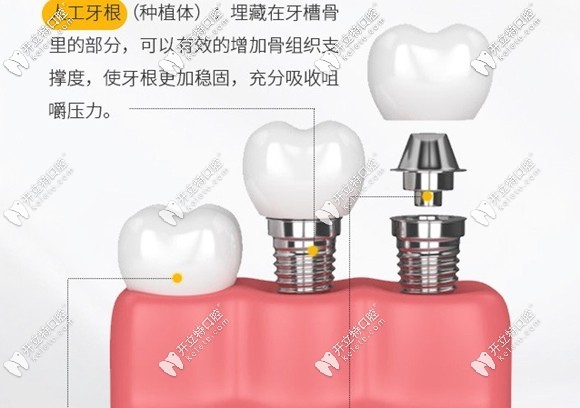 種植牙機(jī)構(gòu)的示意圖