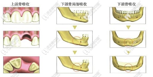 上下牙槽骨吸收缺失程度對(duì)比