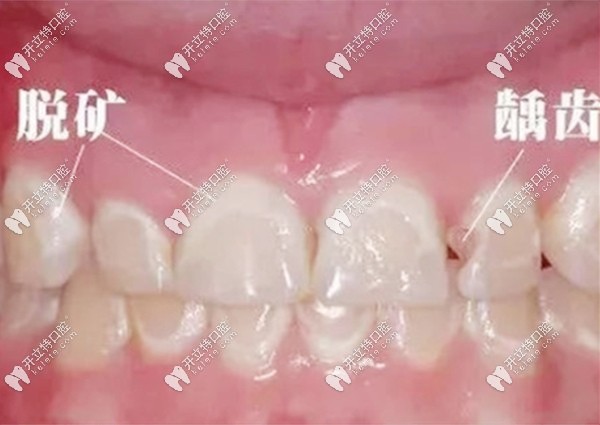 牙齒脫礦和齲齒的圖www.gh0097.com
