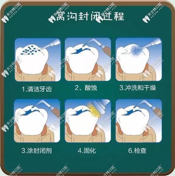 窩溝封閉過程