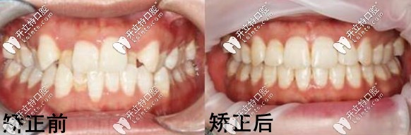在湛江致美矯正牙齒的前后對比