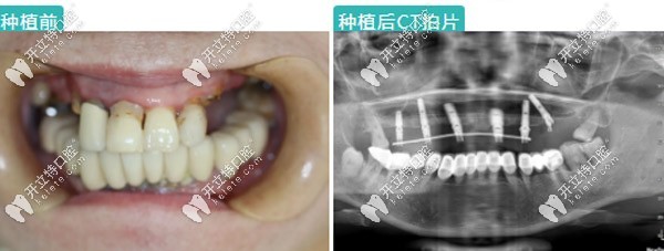這就是我做完半口種植后的CT片