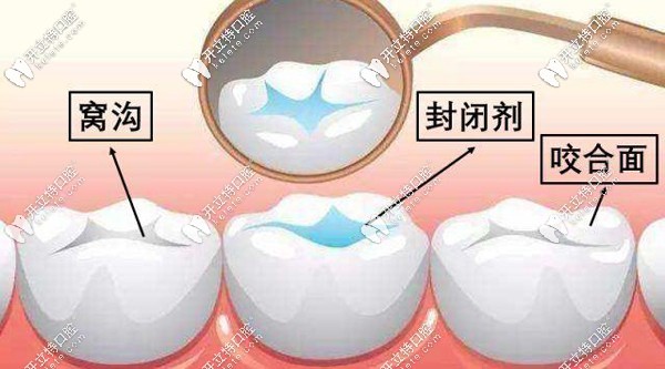 兒童窩溝封閉圖解