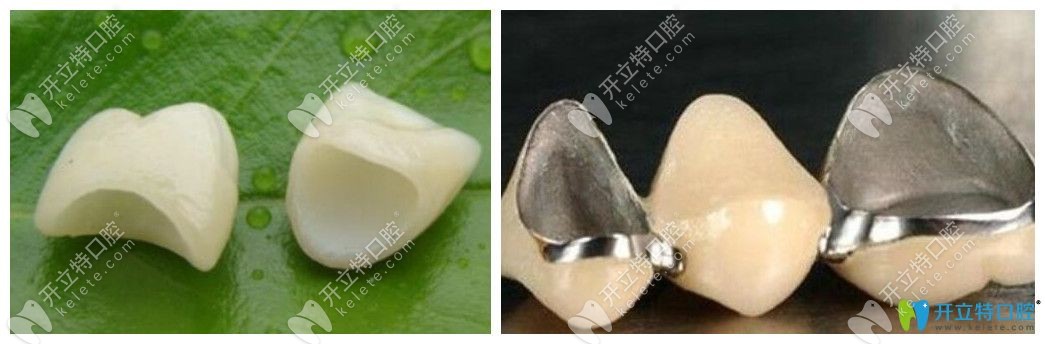 種植牙牙冠的材料主要有哪些呢
