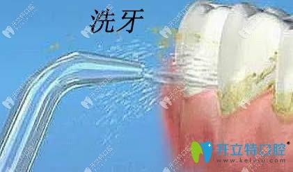 大連昭鶴口腔科普美白牙齒——洗牙圖