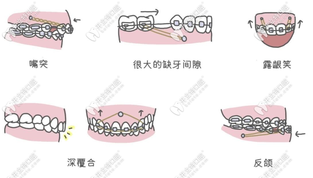 牙齒矯正的類型