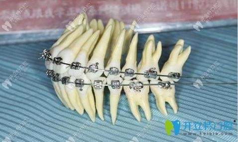 直絲弓和方絲弓的區(qū)別主要在于價格和效果及療程上