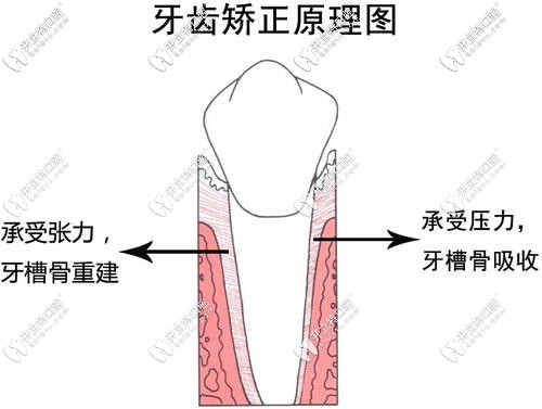 牙齒矯正原理圖