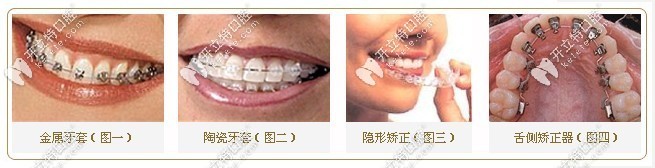幾款常見(jiàn)牙套的外觀