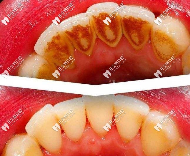 牙齒到底該不該洗