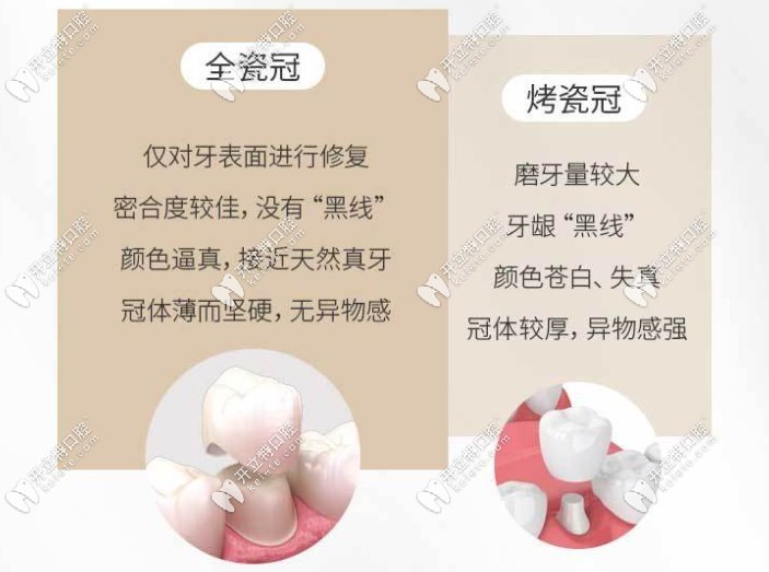 二氧化鋯全瓷牙冠和烤瓷冠優(yōu)缺點對比