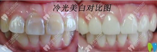 大連昭鶴口腔牙齒冷光美白圖