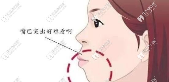 骨性凸嘴外貌