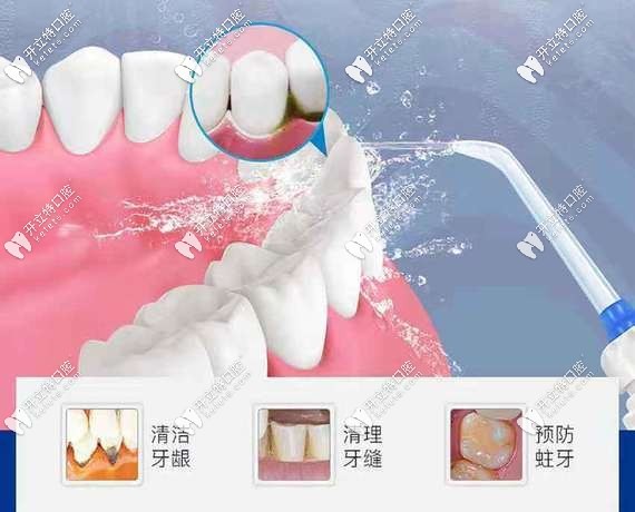 洗牙為什么是健康投資比較劃算的事情
