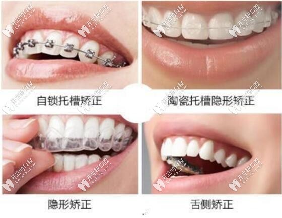 骨性凸嘴戴什么牙套好