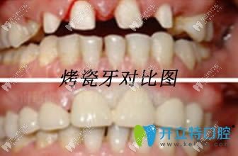 大連昭鶴口腔門診烤瓷牙對(duì)比圖