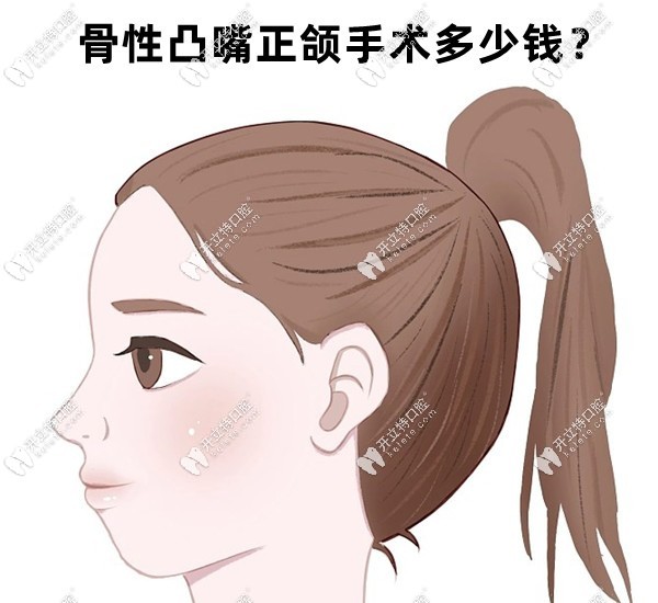 骨性凸嘴正頜手術(shù)多少錢？