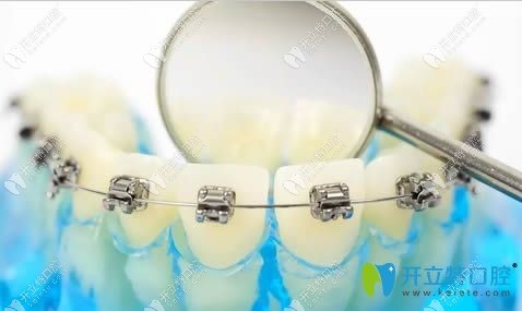 美國mbt矯正技術器
