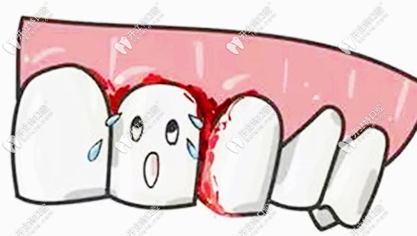 牙齦出血是得牙周病的癥狀之一