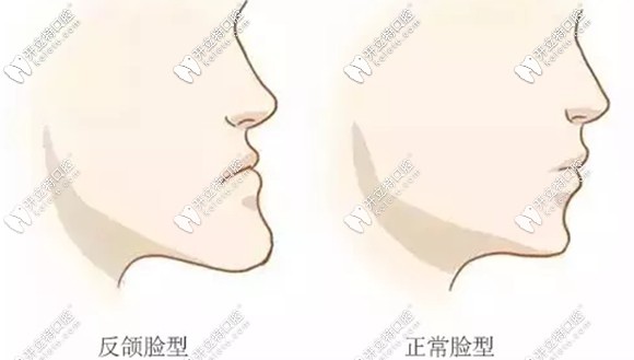  反頜俗稱“月牙臉”造成臉型不美觀