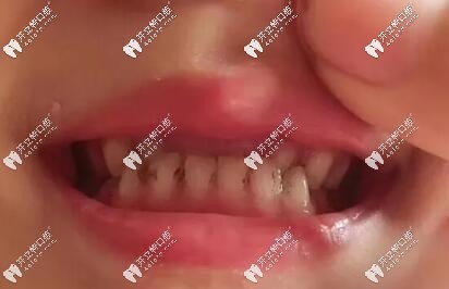 兒童齙牙反頜矯正案例