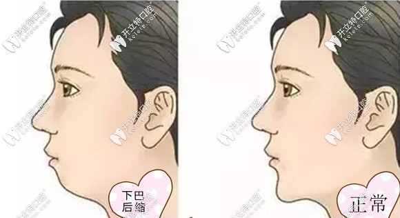 下排牙頜狹窄造成下巴后縮