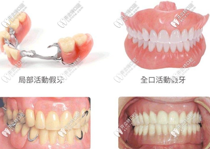 可根据缺牙情况选择义齿