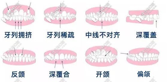 需要正畸的適應(yīng)癥