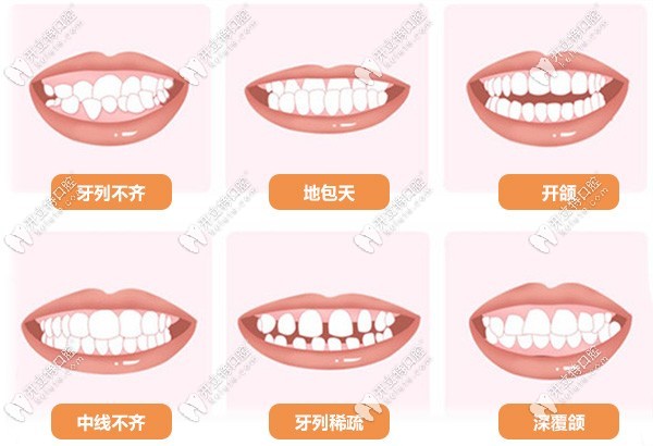 需要做正畸的牙齿问题