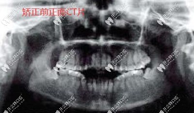 牙槽骨薄牙齒開頜矯正前CT片