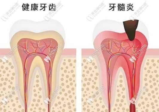 健康牙齒和牙髓炎的對比