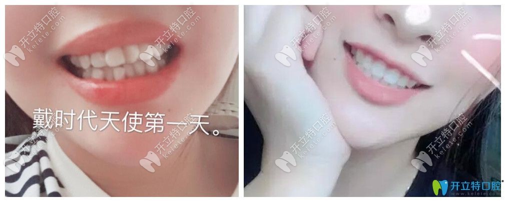 隐形矫正效果好吗？公布宁波牙博士口腔时代天使矫正案例对比效果图