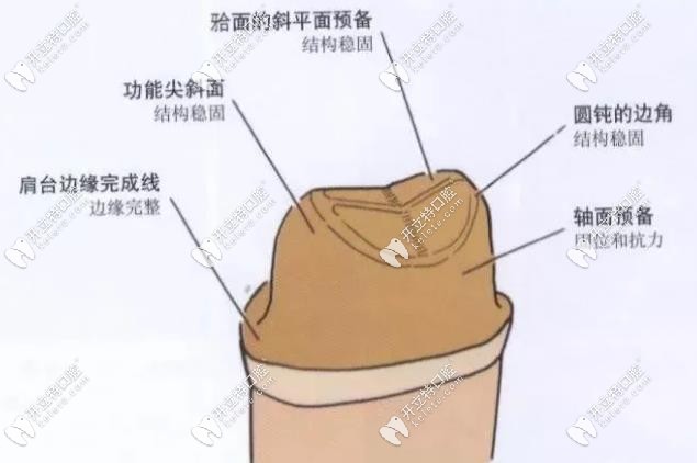 磨牙區(qū)做全瓷冠備牙量的標(biāo)準(zhǔn)要求