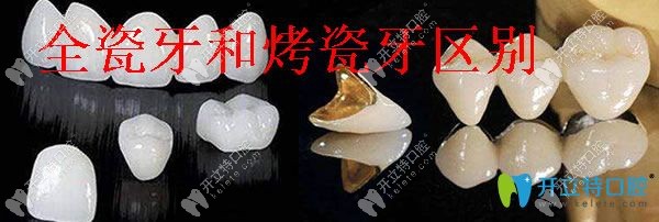 全瓷牙和烤瓷牙區(qū)別