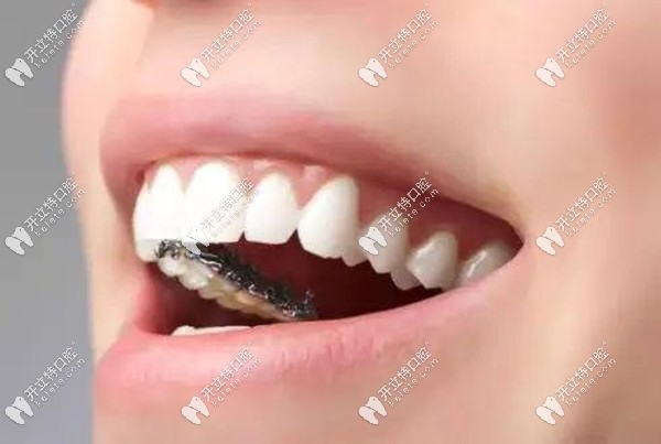 舌側(cè)隱形矯正價(jià)格
