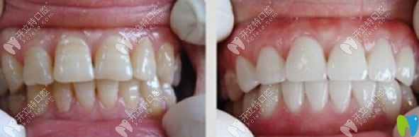 全瓷牙修復(fù)前后效果對比圖