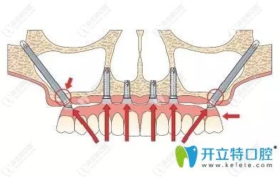 穿顴種植技術(shù)