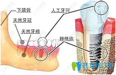 種植牙技術(shù)有哪些