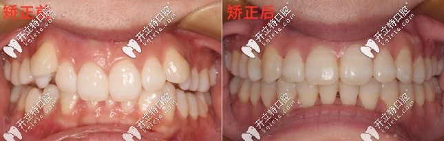 金属矫正前后对比