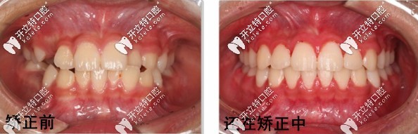 隐形矫正前后对比