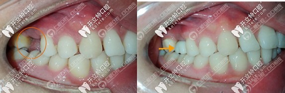 <!--<i data=20240703-sp></i>-->口腔奧齒泰種植牙真人案例