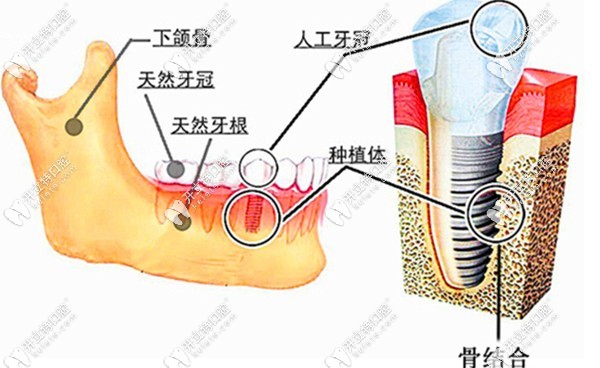 天然牙和种植牙的对比图