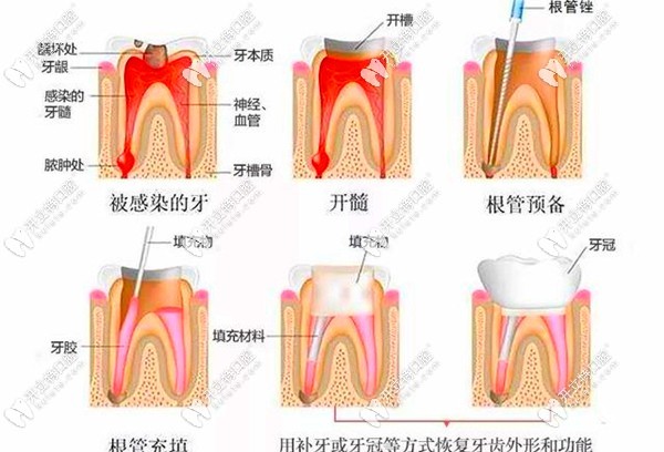 根管治療的過程圖