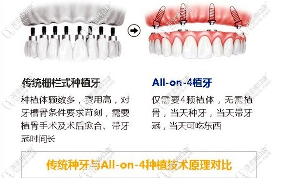 传统种牙和all on 4的原理对比