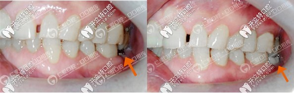 <!--<i data=20240703-sp></i>-->口腔登騰種植牙案例