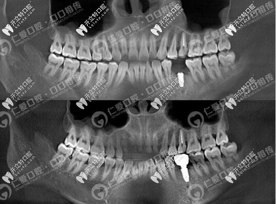 <!--<i data=20240703-sp></i>-->口即拔即種種植牙案例