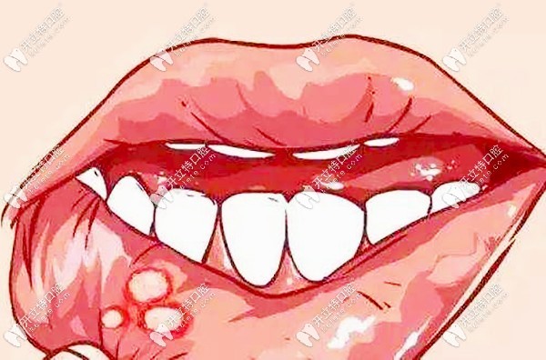 出現(xiàn)口腔潰瘍?cè)趺崔k