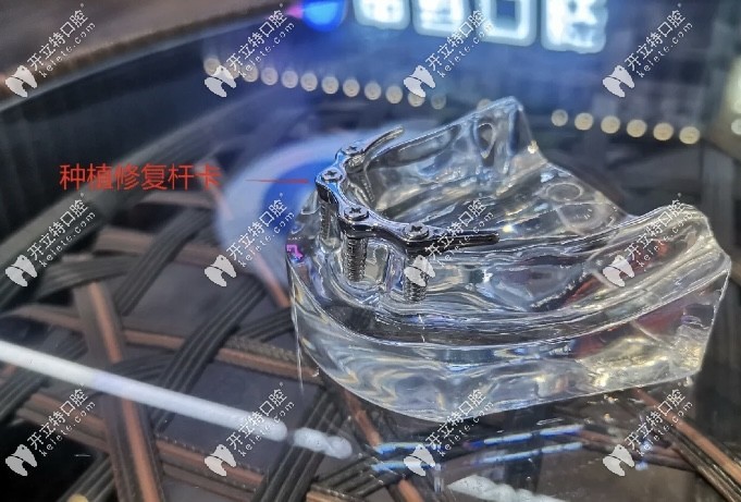 種植修復(fù)桿卡