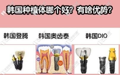 韩国种植体那个好？