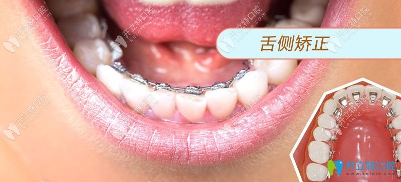 舌侧隐形矫正图示
